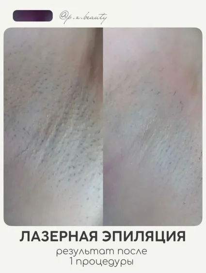 Противопоказания к лазерной эпиляции подмышек: что важно учесть перед процедурой