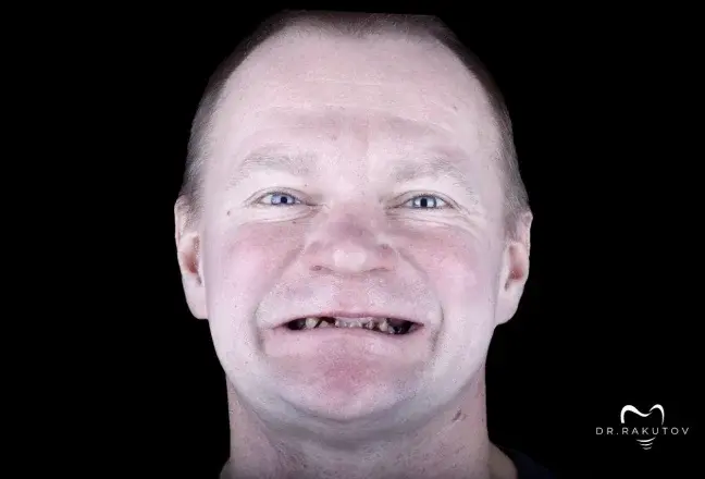 Всё на 4: до лечения